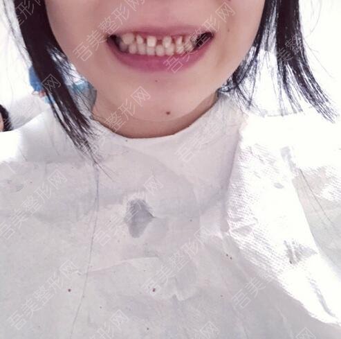上海牙科医院牙齿种植果图