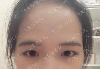 青浦同德医院整形科双眼皮案例分享