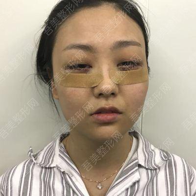 北京圣嘉新医疗美容医院眶隔释放祛眼袋案例分享:术后