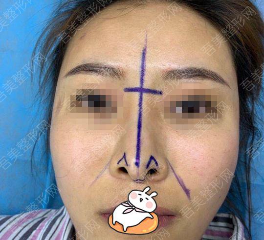 南京医科大学友谊整形外科医院驼峰鼻矫正案例分享:术前