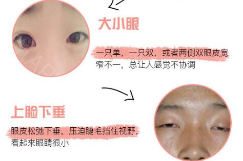 北京协和医院黄久佐医生科普双眼皮手术