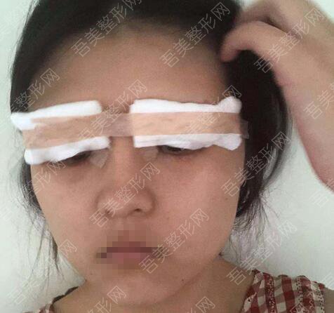 内江熙茜之医疗美容诊所双眼皮案例分享