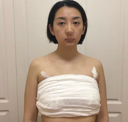 上海华山医院整形科隆胸案例分享