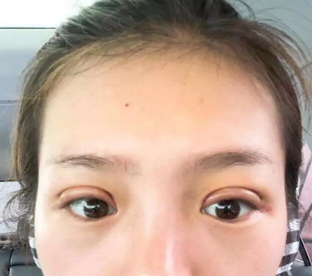 安徽韩美整形外科医院双眼皮案例分享