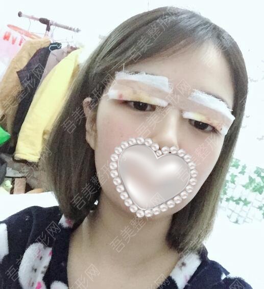重庆世代美医疗美容门诊部割双眼皮案例