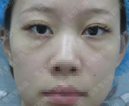 重庆尚韩医疗美容门诊部去眼袋案例