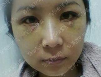 西京医院整形科去眼袋案例：手术前