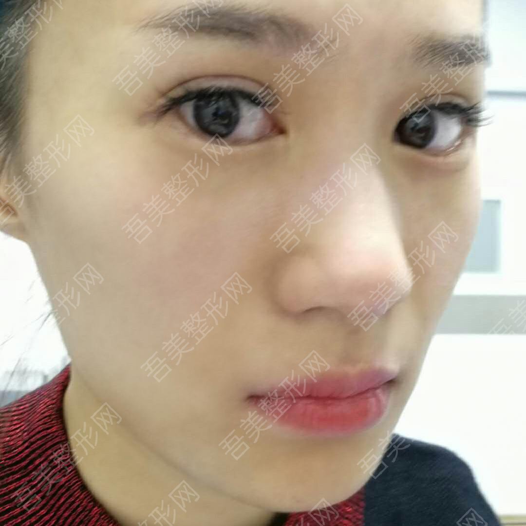 西京医院整形科去眼袋案例：术后