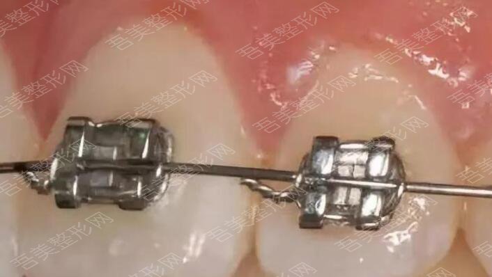 金属矫正牙齿是什么