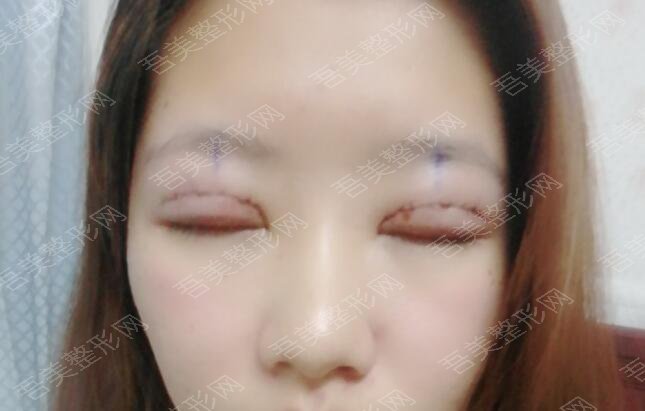 西京医院郝冬月双眼皮手术后一周