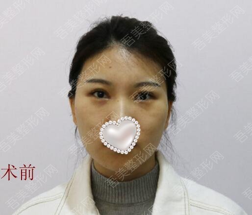 重庆开州爱美医疗美容门诊部玻尿酸填充案例