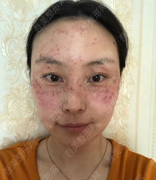 重庆嫦美医疗美容诊所祛斑案例