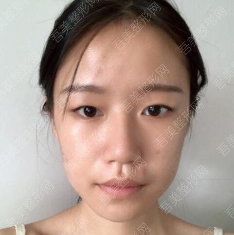 重庆王珍祥医疗美容诊所双眼皮案例