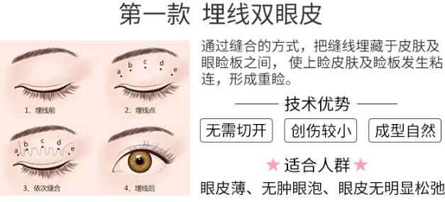 青岛市立医院美容科讲解双眼皮手术知识