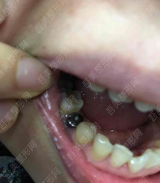 重庆牙博士诚嘉口腔医院牙齿种植案例