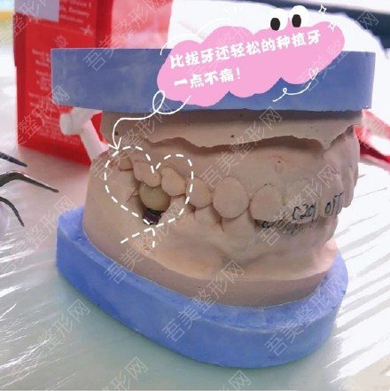 天津市口腔医院牙齿种植案例