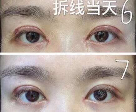 天津市第五中心医院医学整形科割双眼皮案例