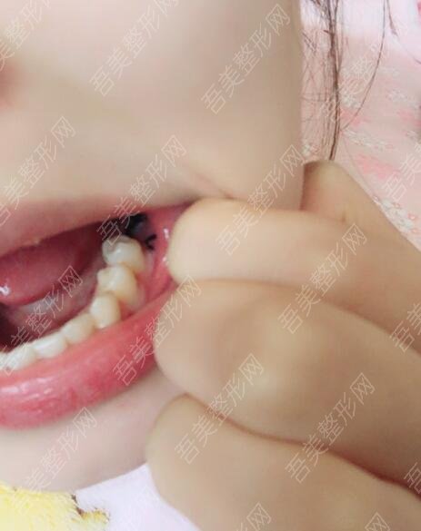 重庆牙科医院种植牙案例