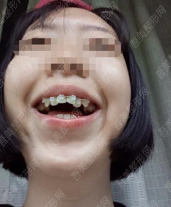 重庆牙科医院牙齿矫正案例