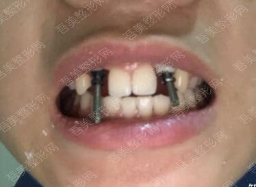 重庆小泊牙口腔医院牙齿种植案例