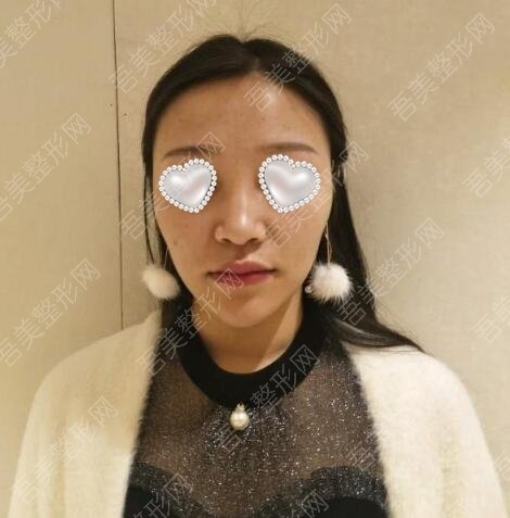 天津华夏医院韩式整形美容科隆鼻案例