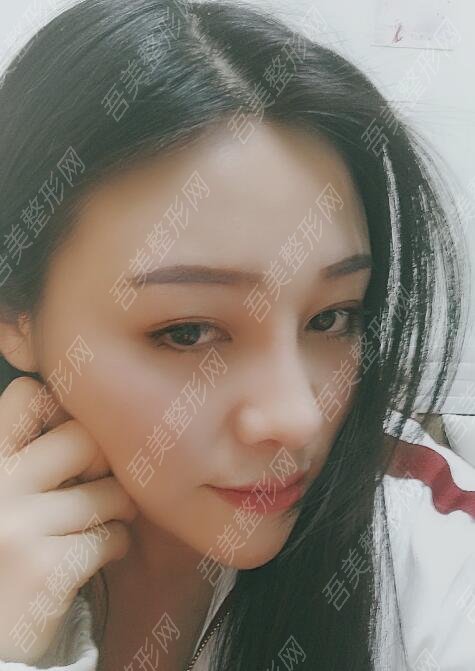 天津华夏医院韩式整形美容科隆鼻案例