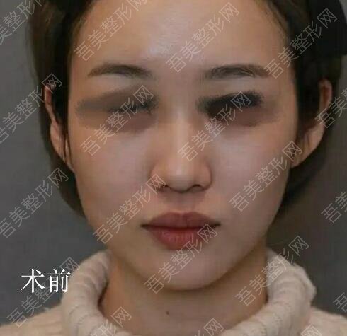 天津现代女子医院整形美容中心隆鼻案例
