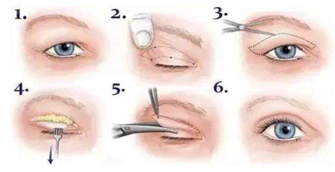 全切双眼皮