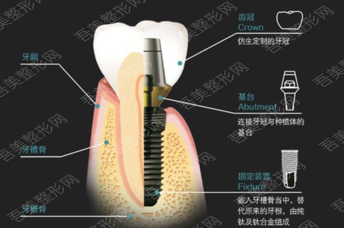 牙齿种植