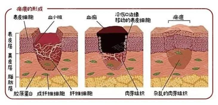 疤痕修复