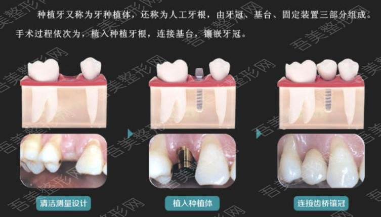 牙齿种植