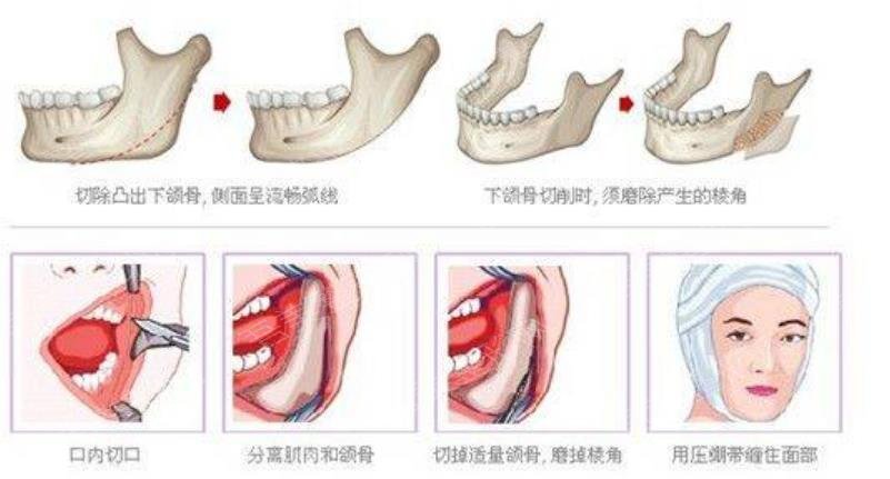 磨骨