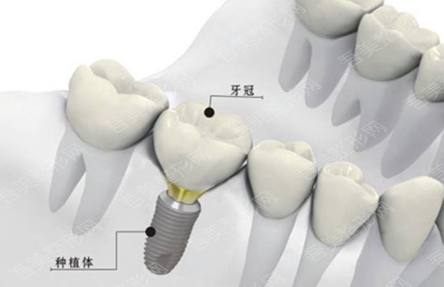 牙齿种植