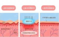 北京大学深圳医院做光子嫩肤好吗？多少钱？有案例对比图哦！