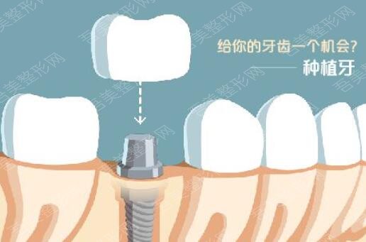 牙齿种植动漫21.jpg