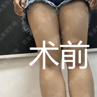 韩国延世整形医院大腿吸脂案例