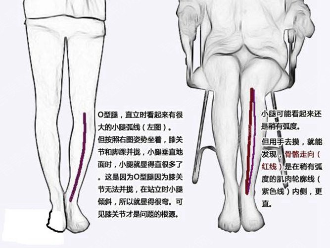 O型腿矫正