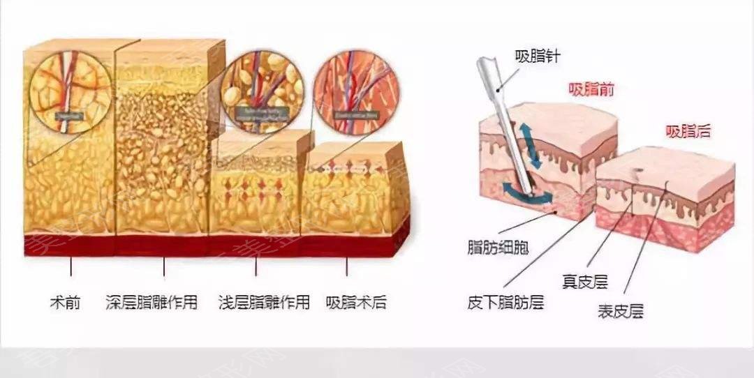 萍乡丽芙整形医院科普吸脂减肥