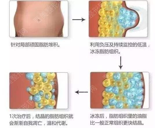 萍乡丽芙整形医院科普吸脂减肥