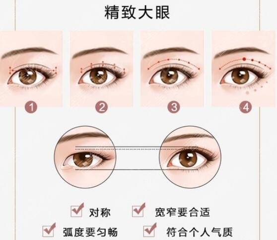 西京医院整形外科科普双眼皮相关知识