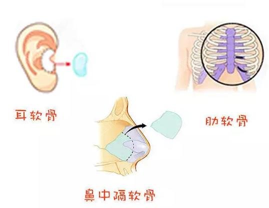 重庆华美整形彭绍宗医生科普隆鼻知识