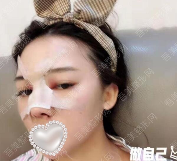 重庆华美整形李超隆鼻案例分享