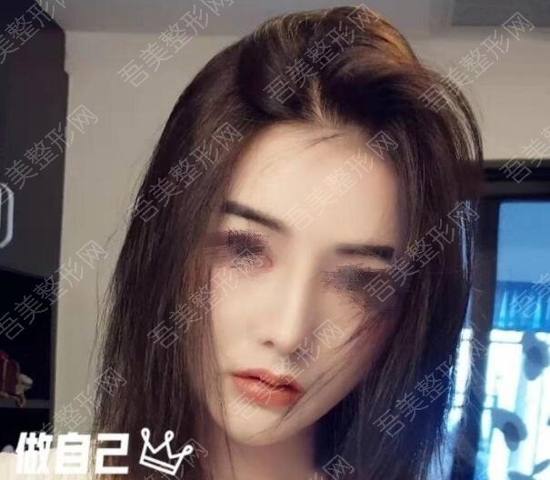 重庆华美整形李超隆鼻案例分享