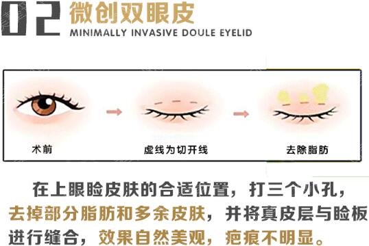 布仁医生科普双眼皮手术