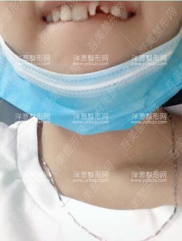 邓悦医生牙齿修复案例