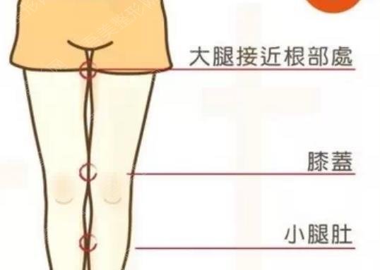 大腿吸脂