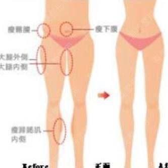 大腿吸脂