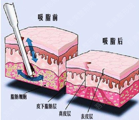 面部吸脂