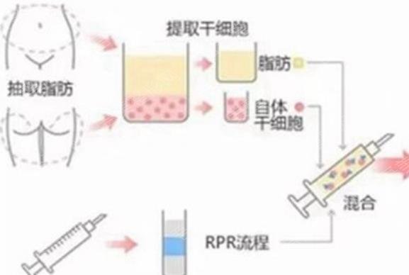 脂肪移植